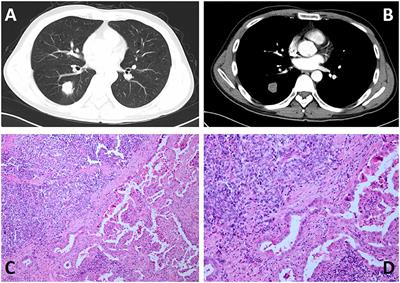 Case Report: Combined Small Cell Lung Carcinoma With Pulmonary Adenocarcinoma